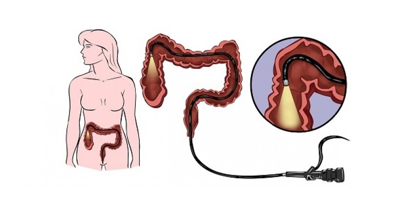 Как делается колоноскопия фото